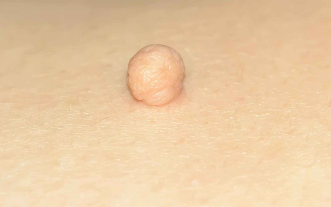 Skin Tag di Kulit Bayi, Ini Cara Mencegah dan Menghilangkannya